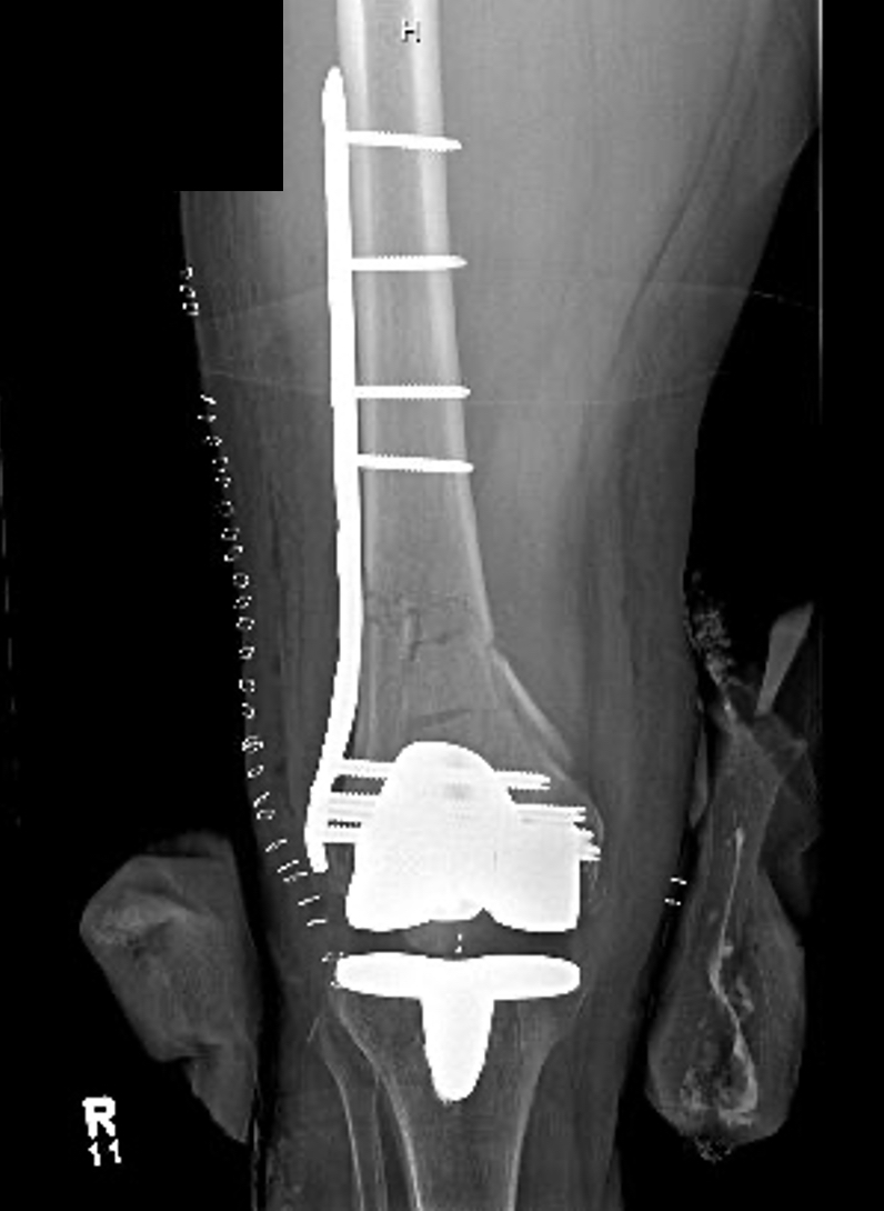 Early Weight Bearing after Distal Femur Fractures in the Elderly: A  Prospective, Cohort Pilot Study | Published in Journal of Orthopaedic  Experience & Innovation