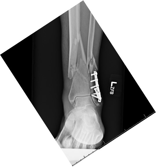 Broken Leg: If my tibial shaft fracture gets surgery, when can I