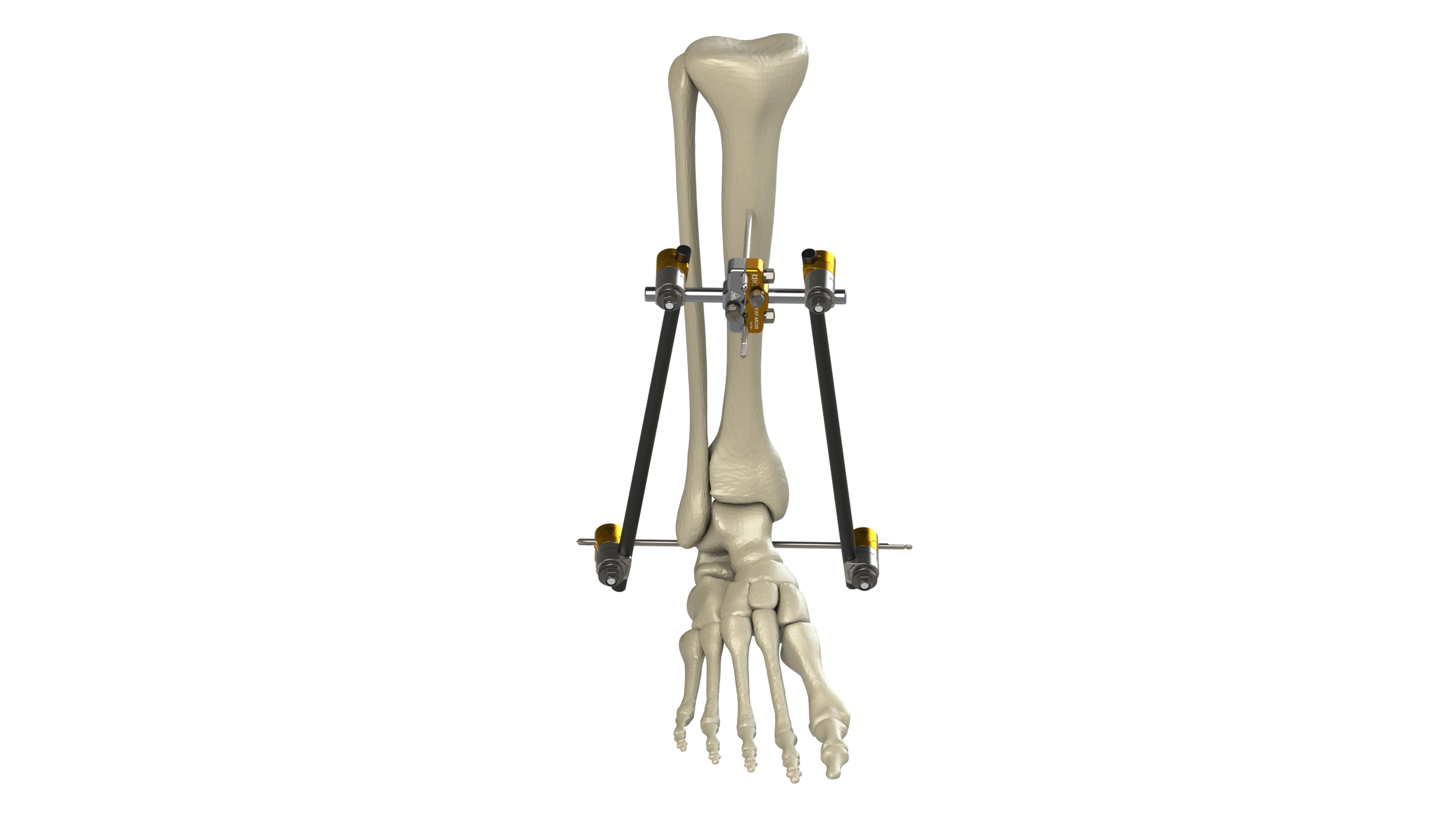 Orthopedic Instrument Trauma Tibial External Fixator System for Tibia  Fracture - China Synth External Fixation, External Fixator