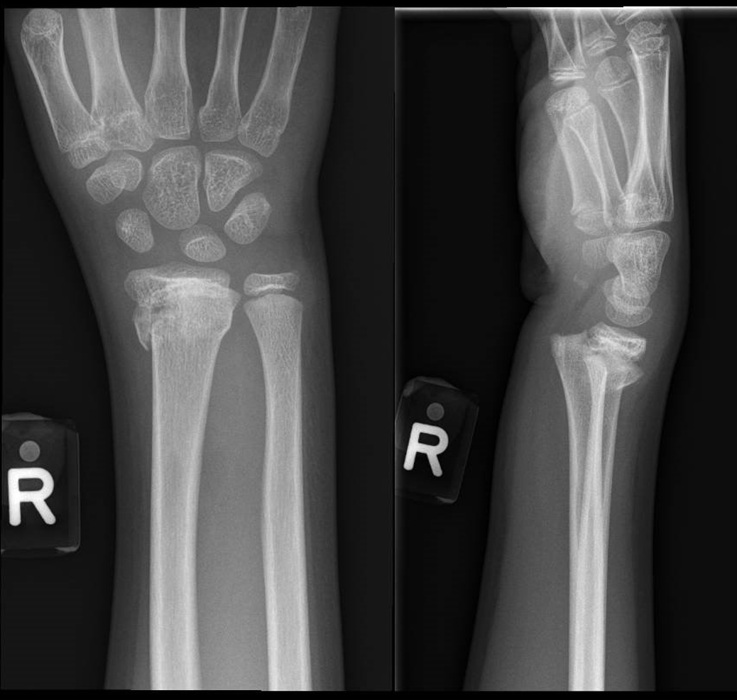 Displaced paediatric distal radius fractures with volar skin