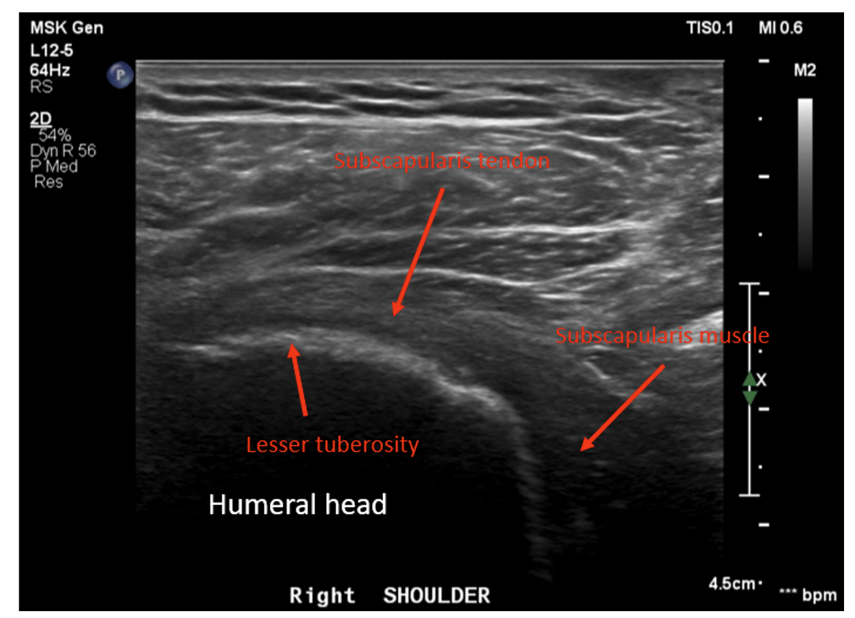 Biologic Augmentation Of The Subscapularis Tendon During Anatomic Shoulder Arthroplasty A