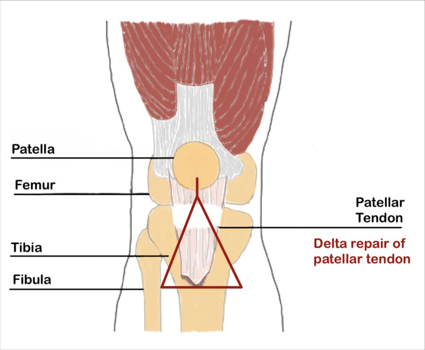 Delta technique reconstruction of a failed patellar tendon repair