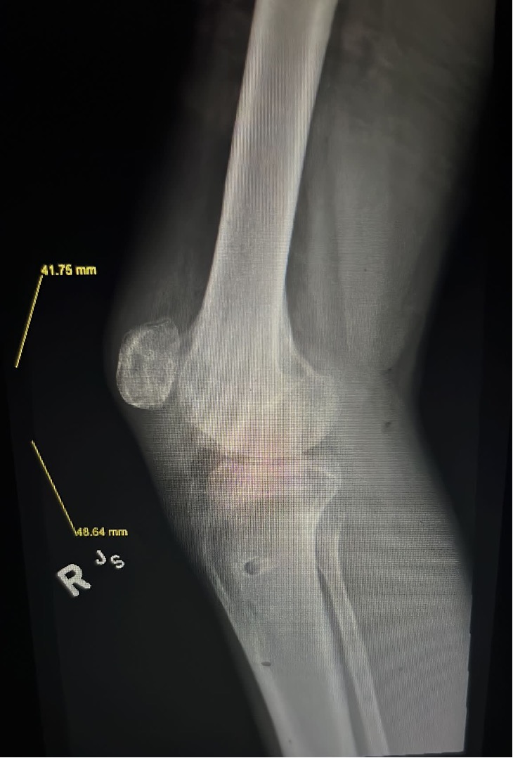 Delta technique reconstruction of a failed patellar tendon repair