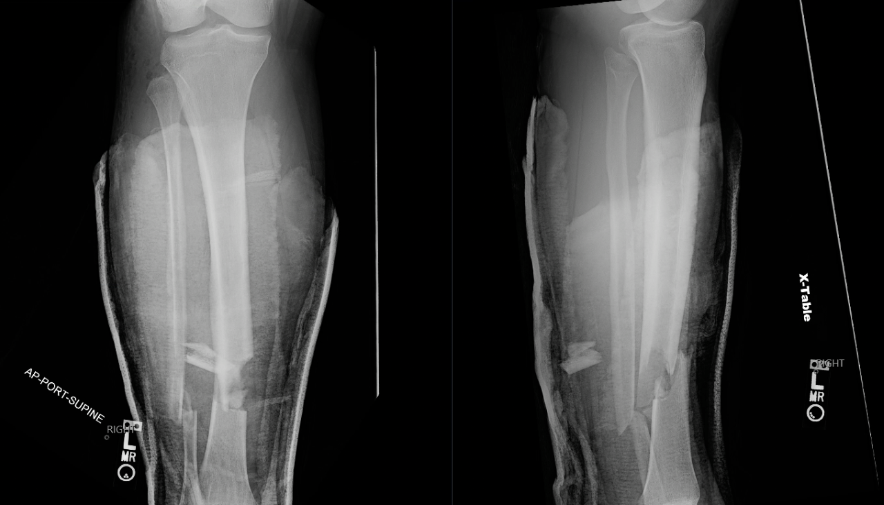 Locking retrograde nail, non-locking retrograde nail and plate fixation in  the treatment of distal third femoral shaft fractures: radiographic, bone  densitometry and clinical outcomes | Journal of Orthopaedics and  Traumatology | Full
