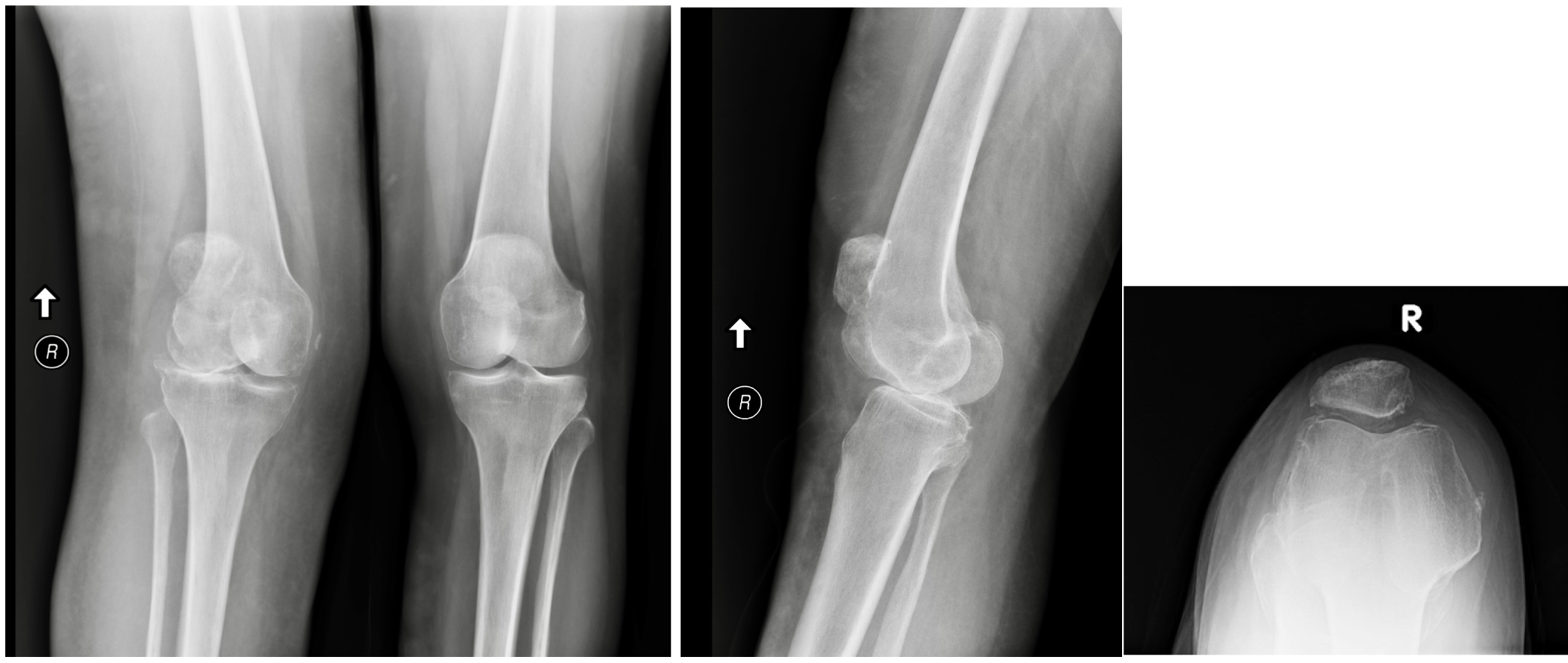 Preoperative long-leg alignment and sample X-rays