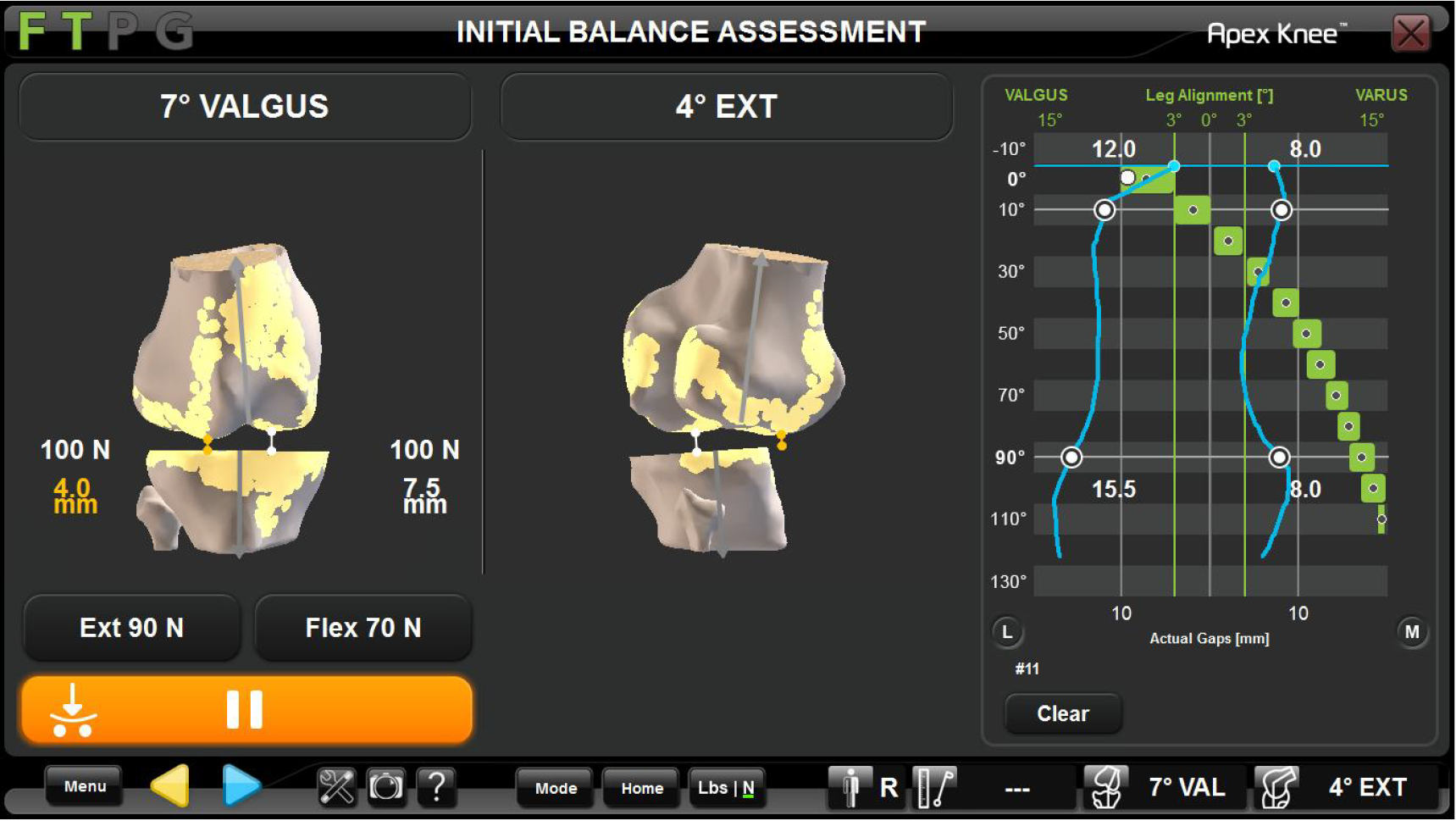 Robotic Assisted Total Knee Arthroplasty In Arthrofibrosis Or The ...