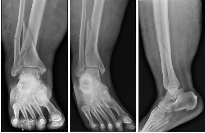 Right calcaneal fracture in a 36-year-old male patient treated with