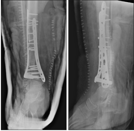 THE MANAGEMENT OF INFECTED NONUNION TIBIA SHAFT WITH ILIZAROV RING