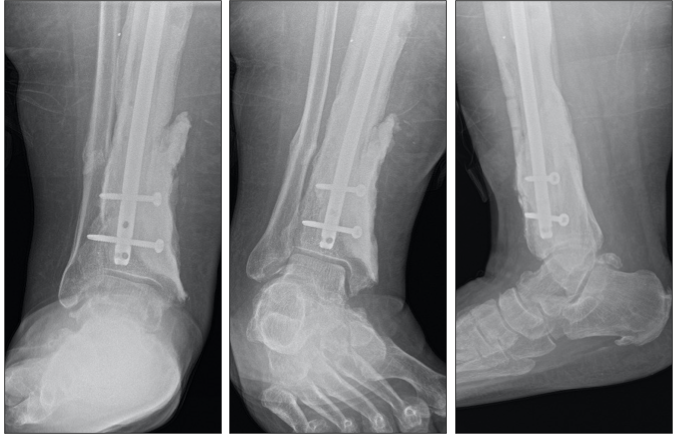 THE MANAGEMENT OF INFECTED NONUNION TIBIA SHAFT WITH ILIZAROV RING